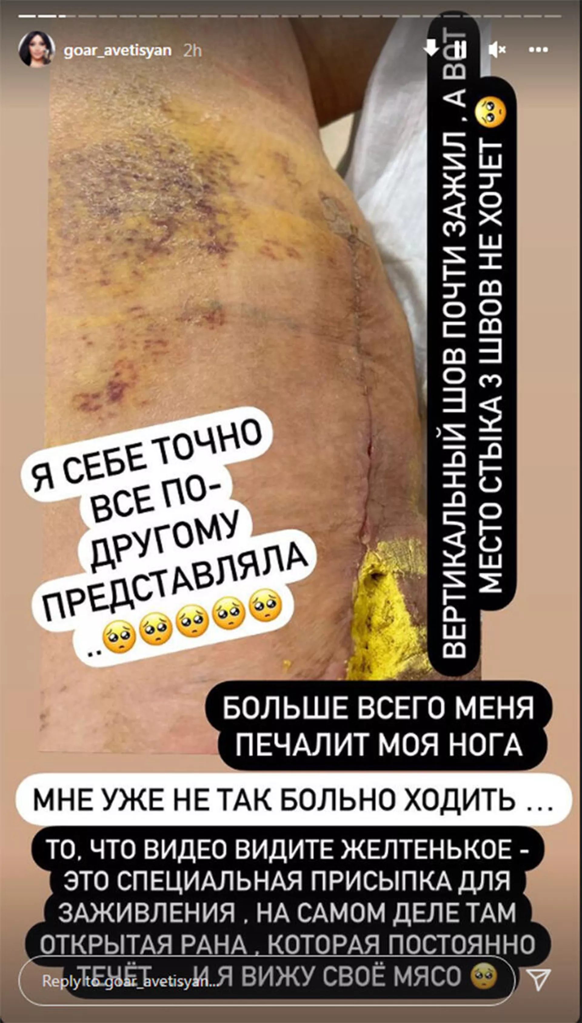 Instagram story Гоар Аветисян