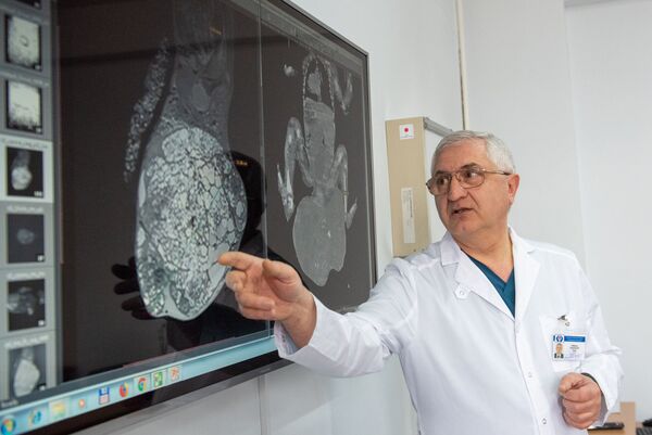 В Ереване провели уникальную операцию по удалению огромной опухоли у новорожденного - Sputnik Армения