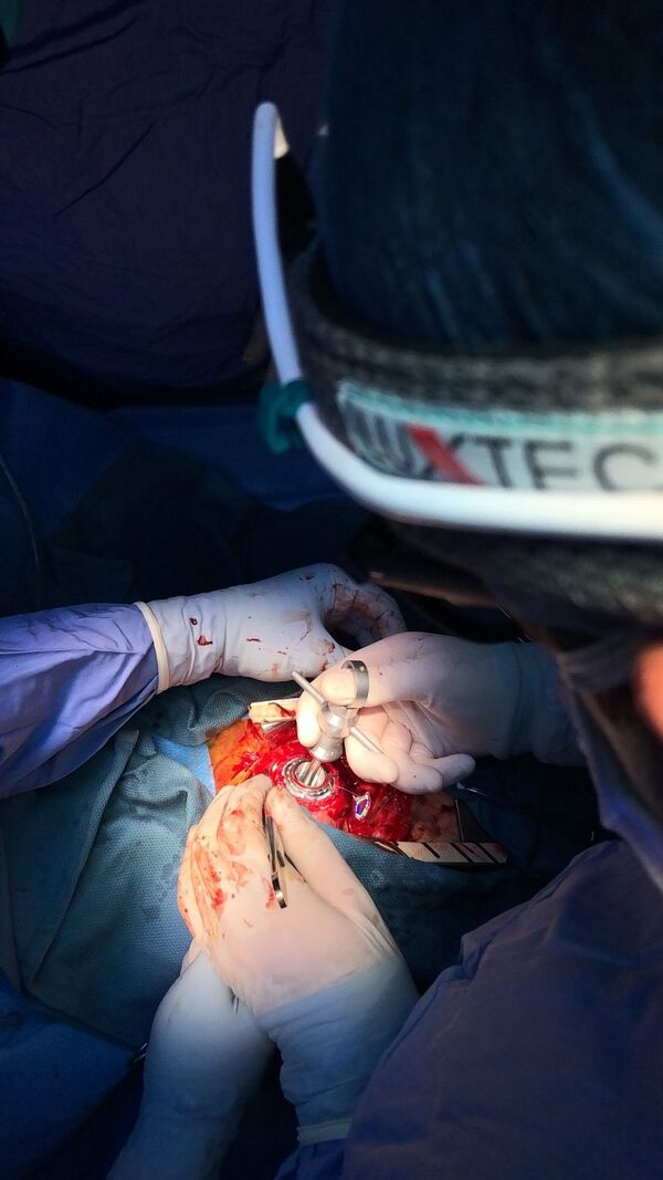 Հայաստանում կատարված սրտի բացառիկ վիրահատությունը` լուսանկարներով Հայաստանում կատարված սրտի բացառիկ վիրահատությունը` լուսանկարներով - Sputnik Արմենիա