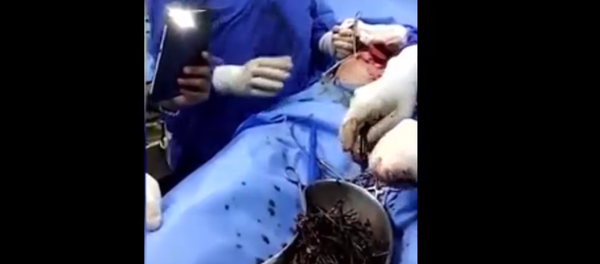 Индиец проглотил 600 гвоздей - Sputnik Армения