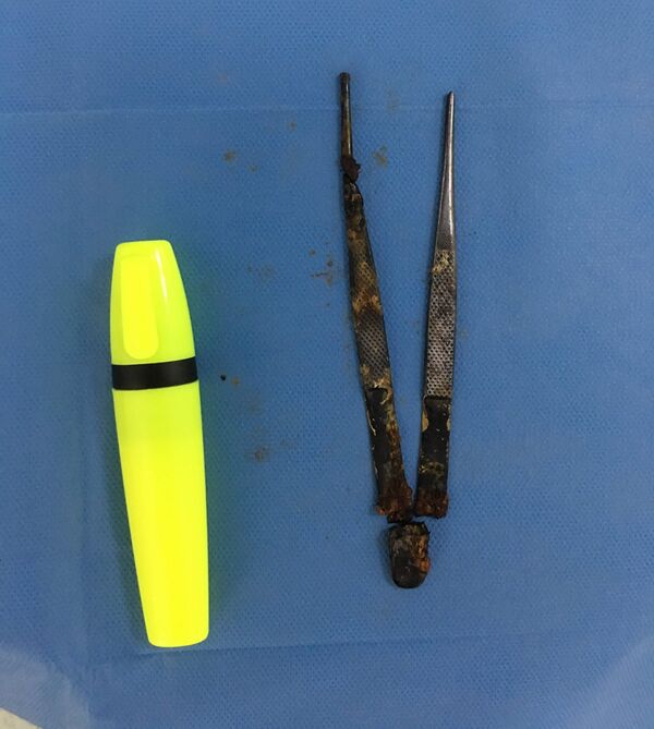 Пинцет, забытый во время операции - Sputnik Армения